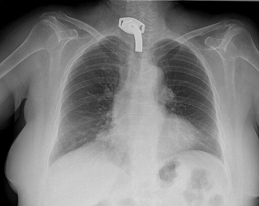 Trachealkanüle in einem Röntgenbild des Thorax
