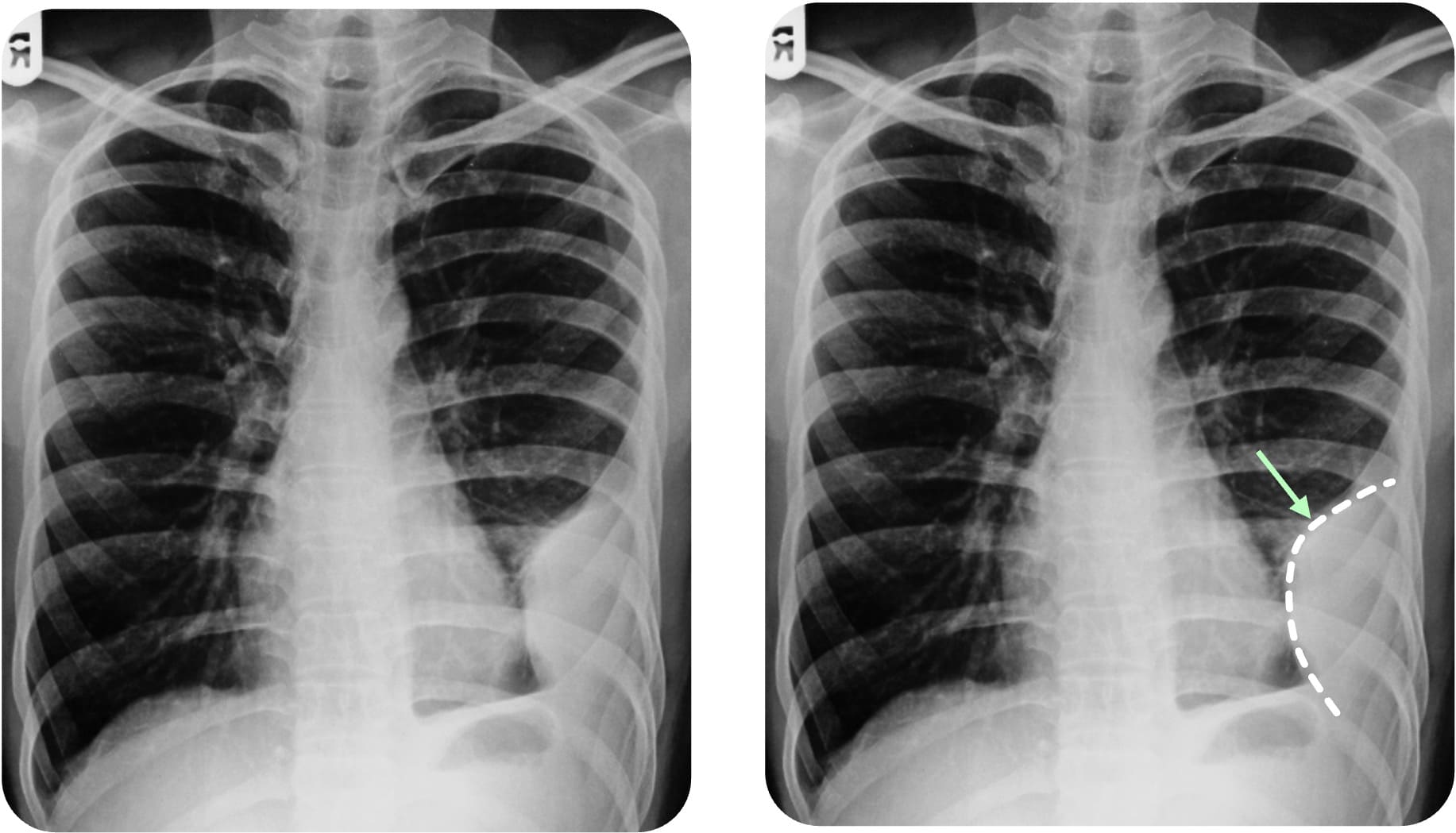 Abgekapselter Erguss im Röntgen-Thorax