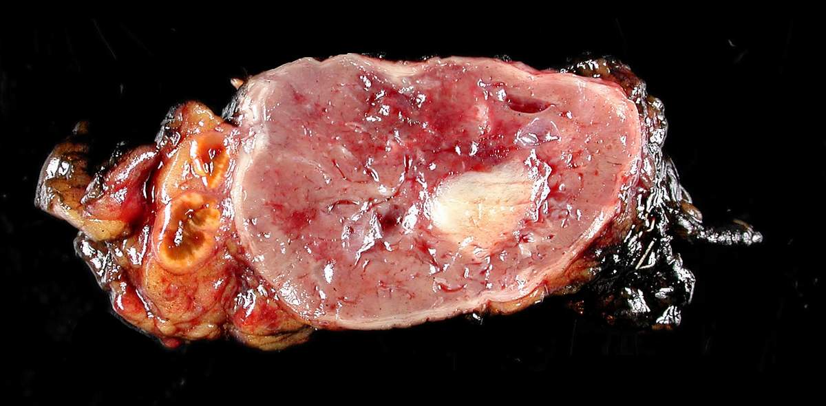 Phäochromozytom – Schnittfläche