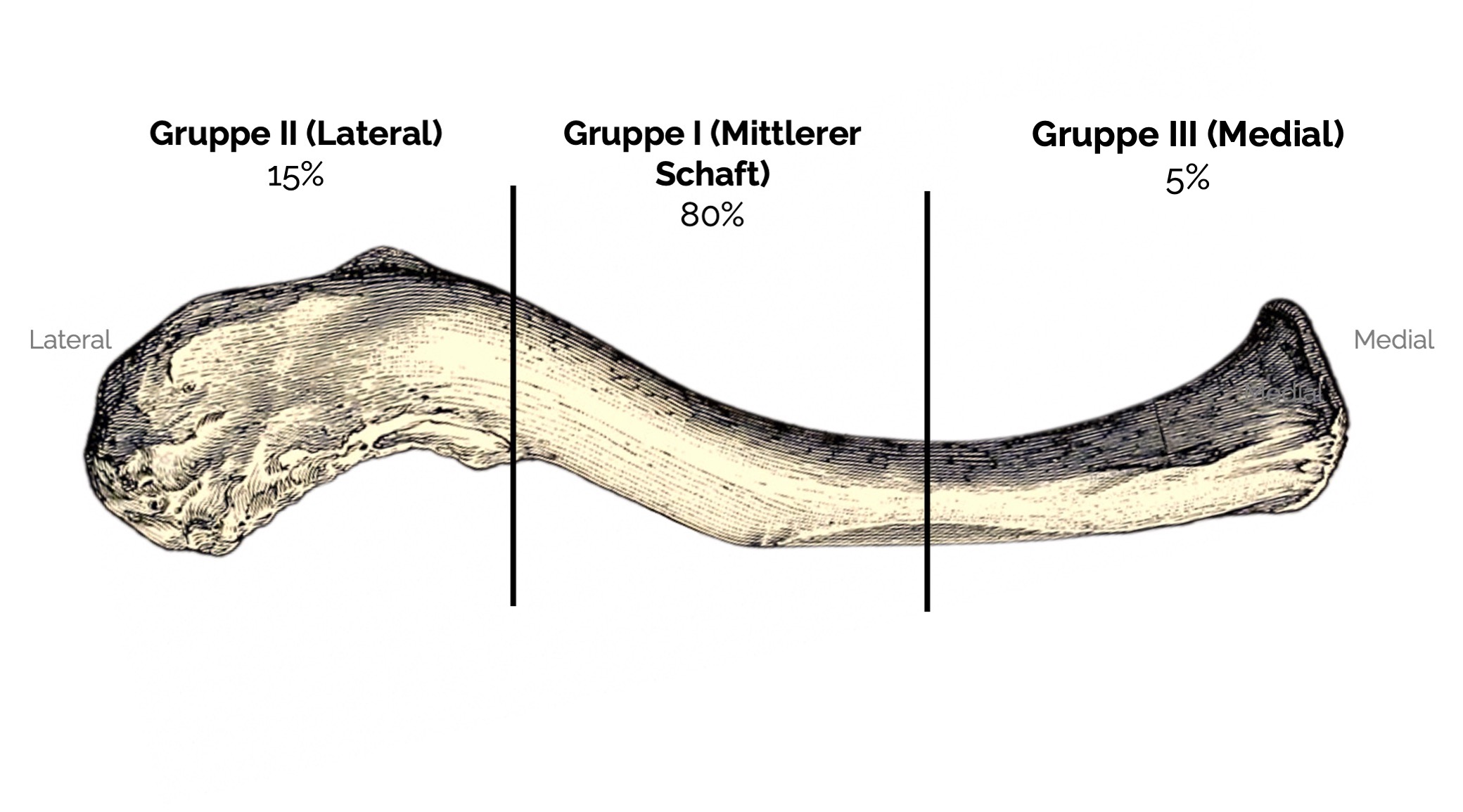 Allman-Klassifikation