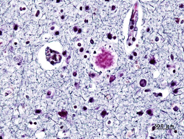 Amyloid-Plaques