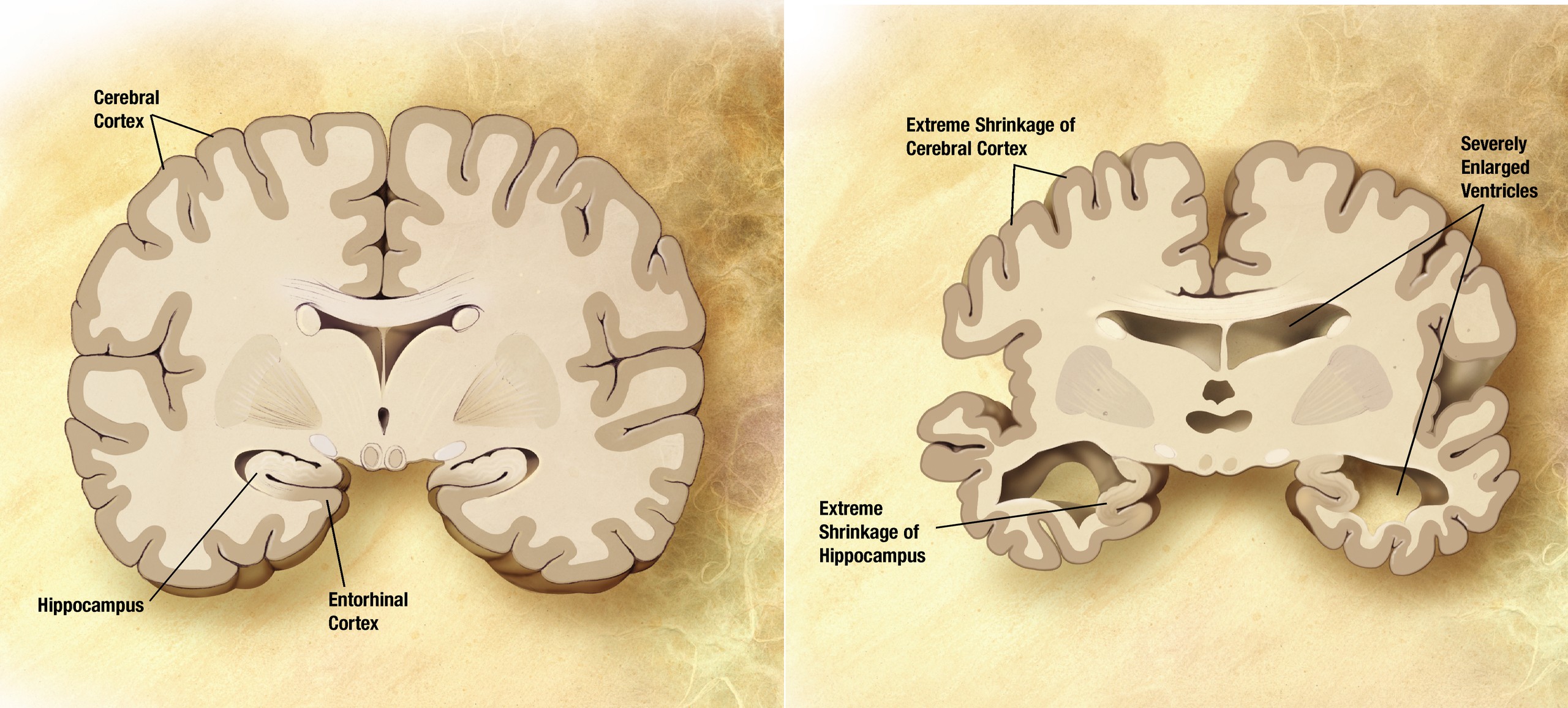 Makroskopische Veränderungen des Gehirns bei Alzheimer