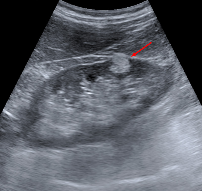 Sonografische Aufnahme der Nieren mit Angiomyolipom