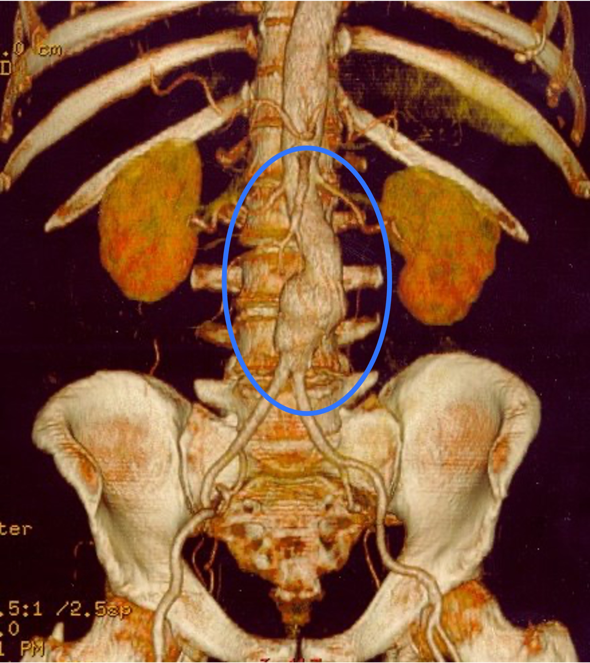 Rekonstruierte 3D-Computertomographie (CT): abdominelles Aortenaneurysma