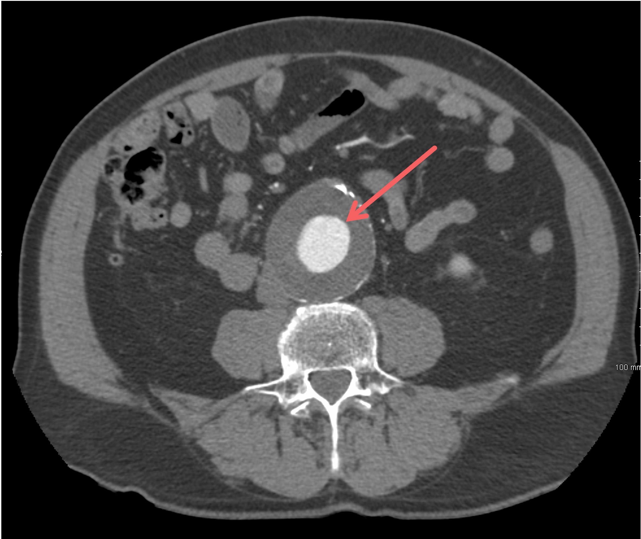CT-Angiographie: abdominelles Aortenaneurysma