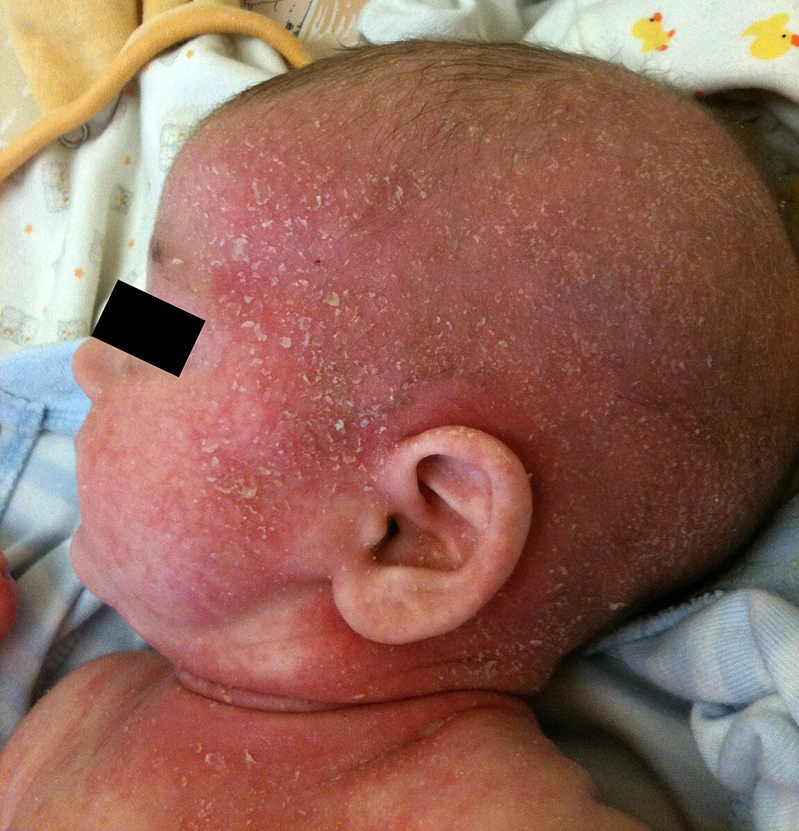 Atopische Dermatitis eines Säuglings