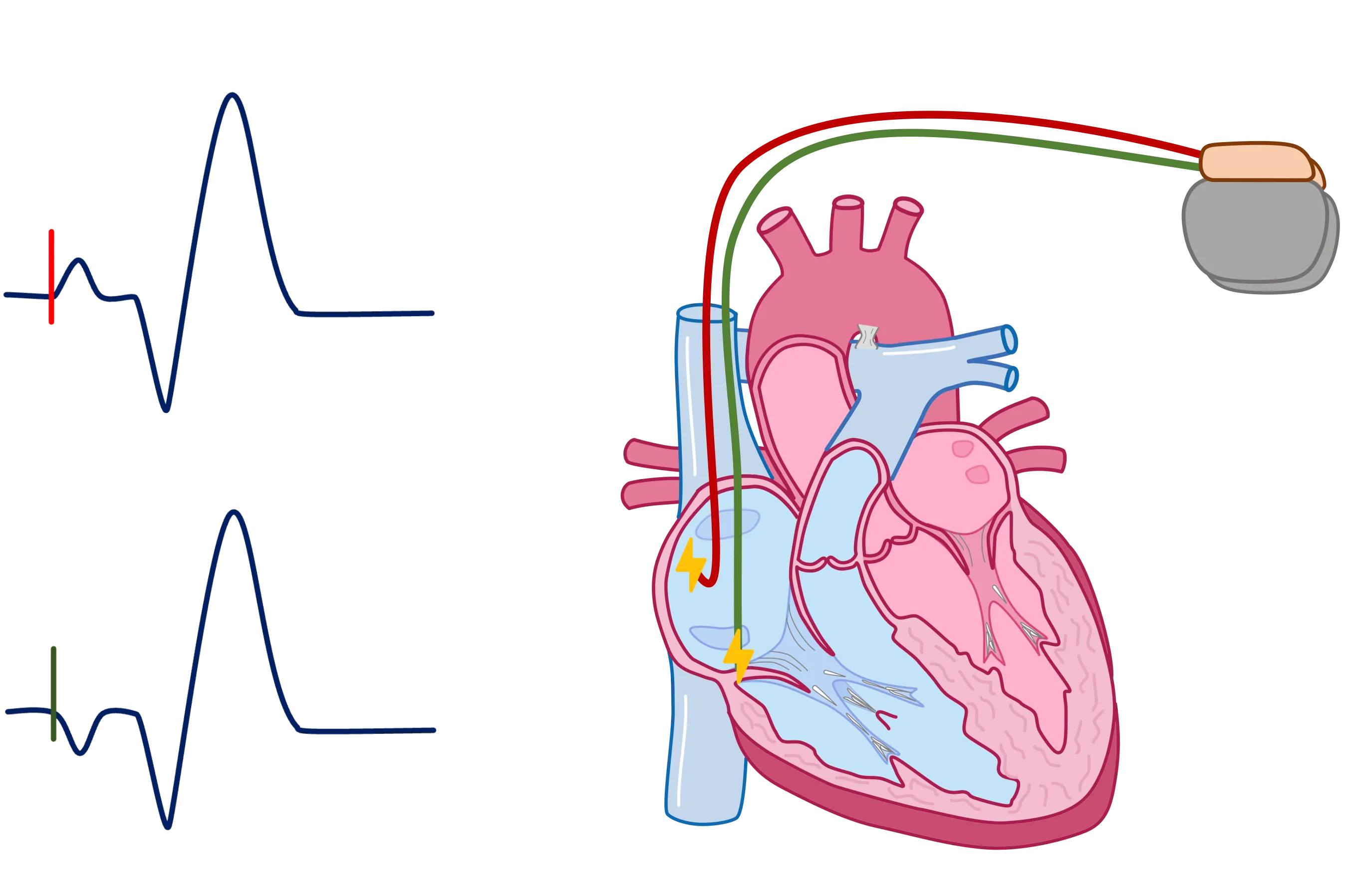 Atriale Schrittmacherstimulation