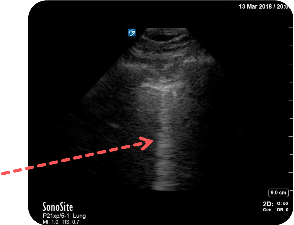 Sonographische Darstellung einer B-Linie, „Kometenschweifartefakt“