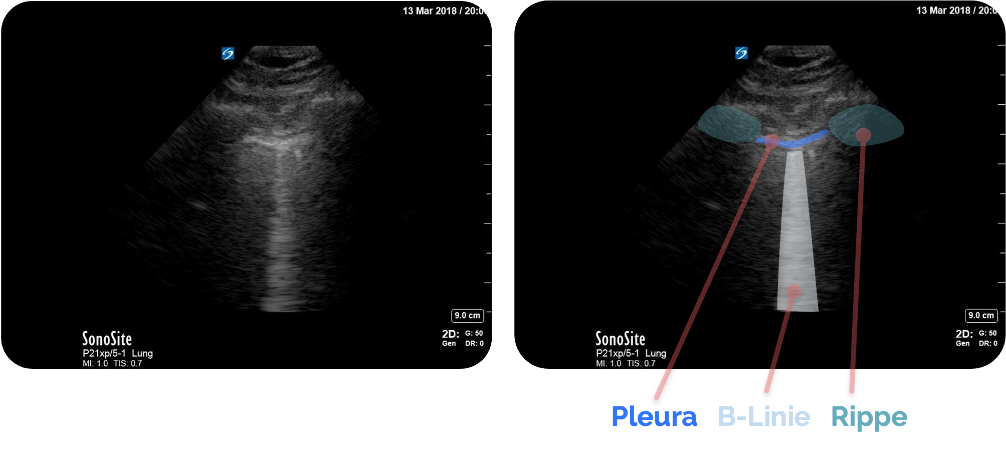 Sonographische Darstellung einer B-Linie, „Kometenschweifartefakt“