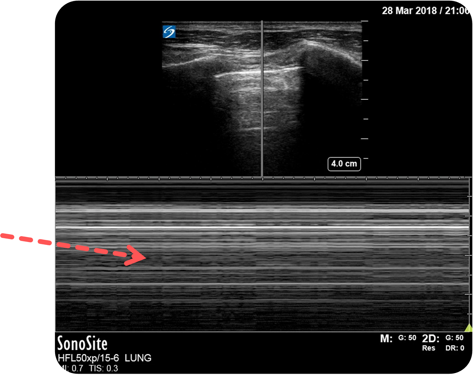 Pneumothorax im M-Mode