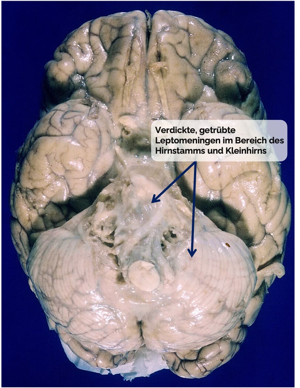 Basale Meningitis bei tuberkilöser Meningitis