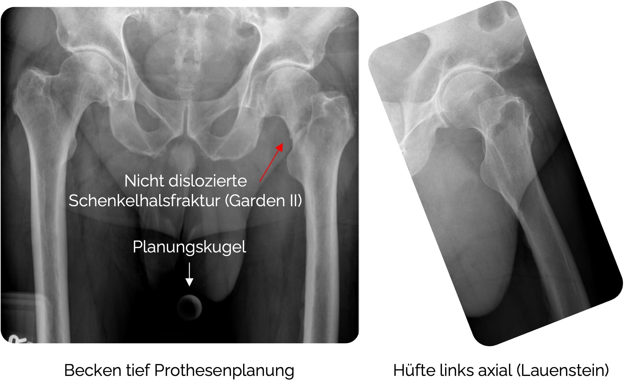 Nicht dislozierte Schenkelhalsfraktur (Garden II)