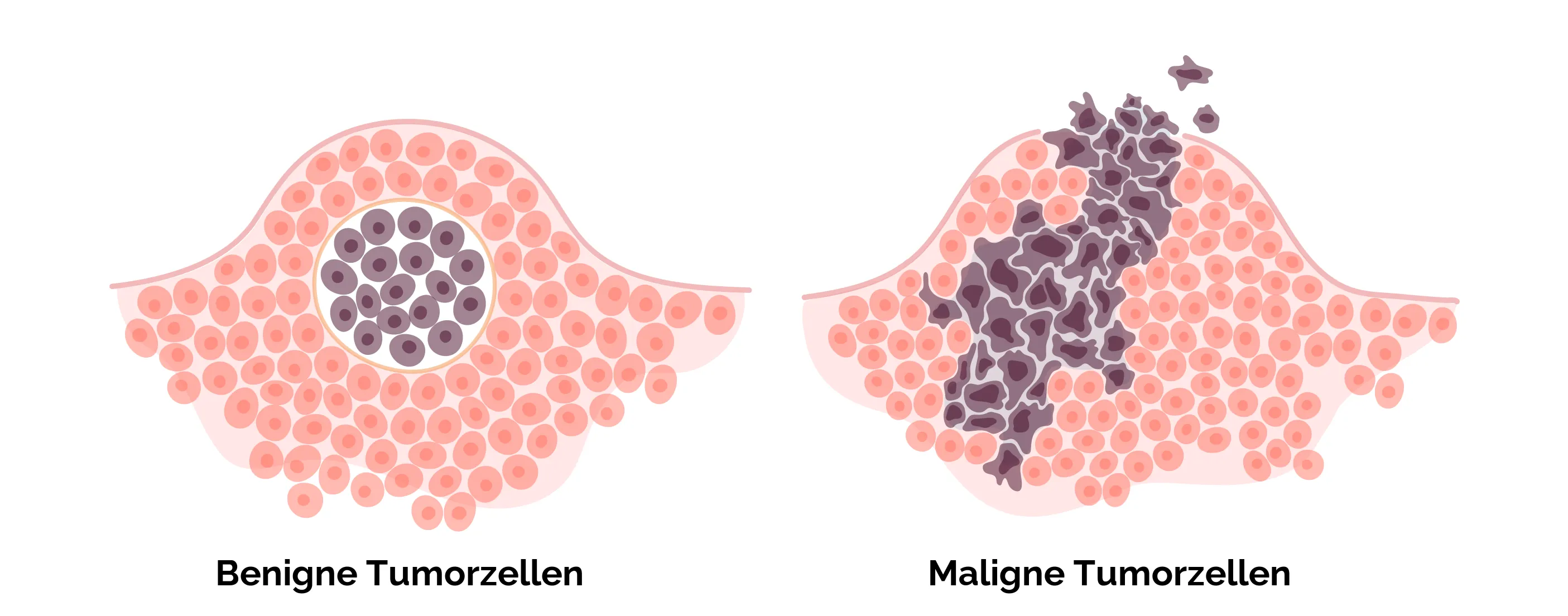 Benigne vs. maligne Tumorzellen