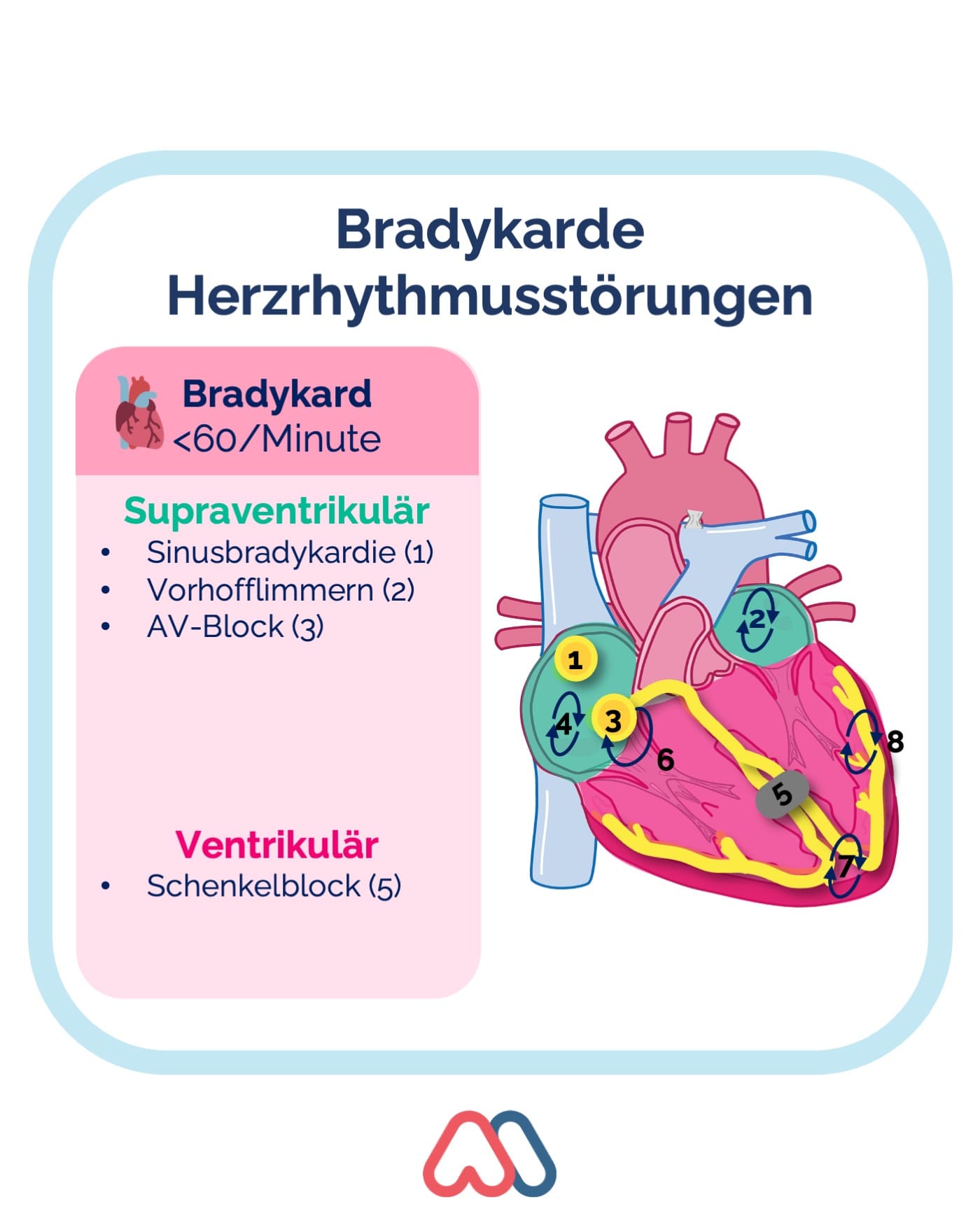 Bradykarde Herzrhythmusstörungen - Ein Überblick