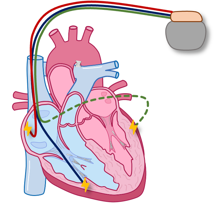 Kardiale Resynchronisationstherapie (Cardiac resynchronization therapy/CRT)