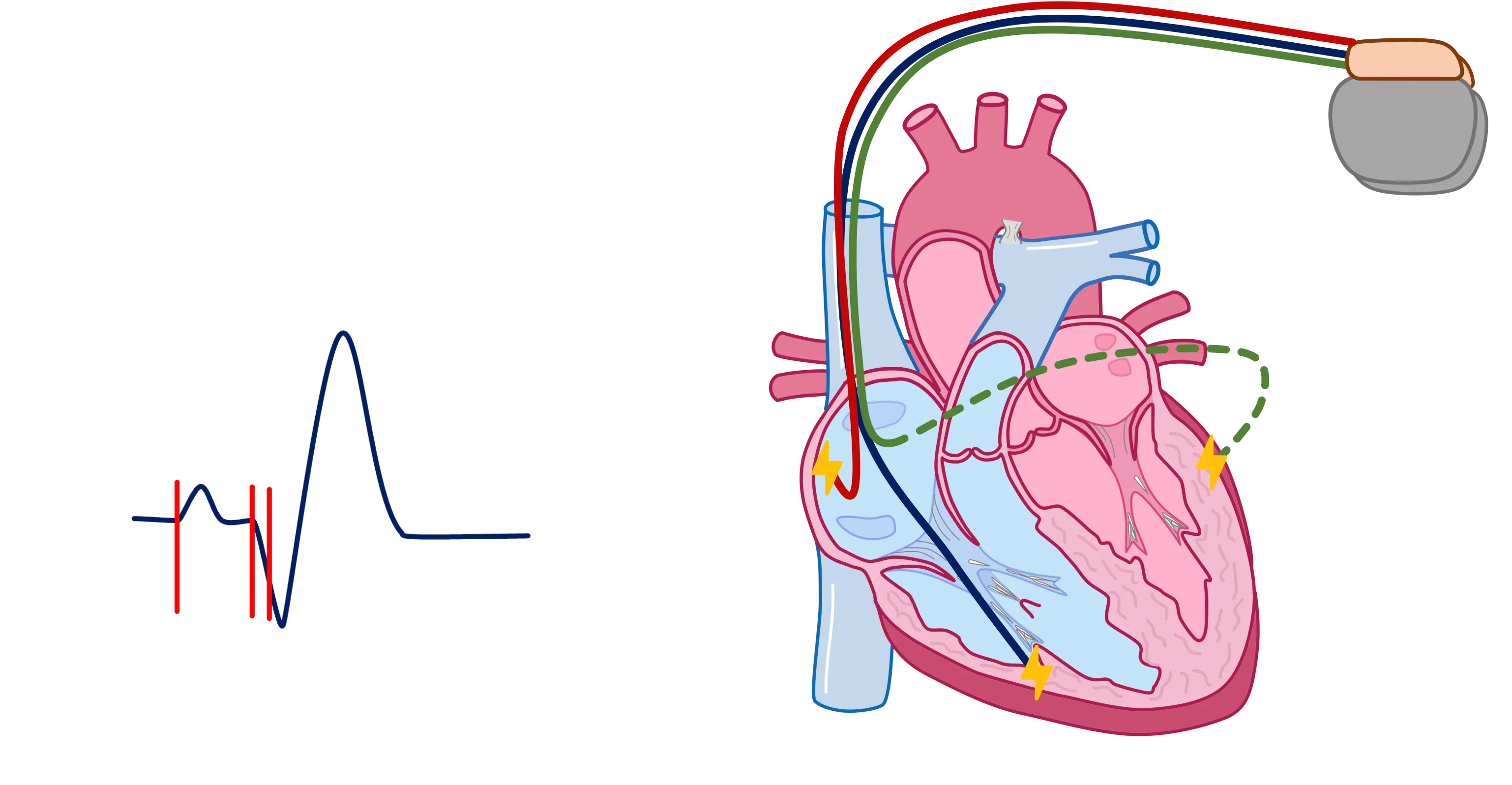 Cardiac Resynchronization Therapy (CRT) EKG