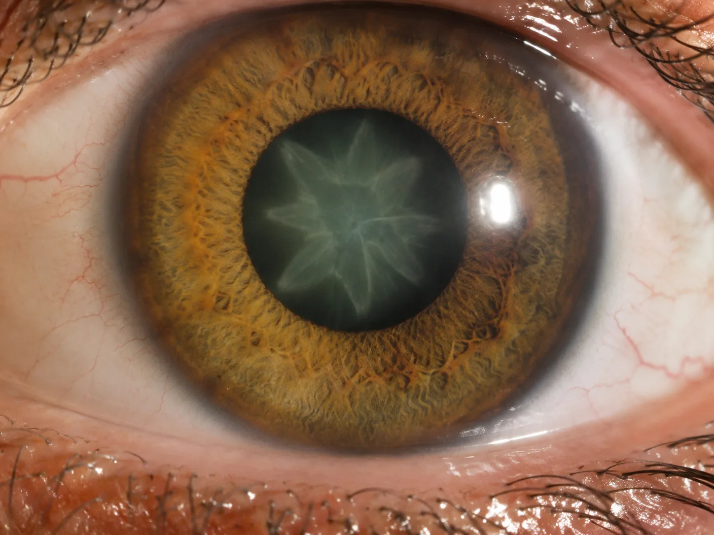 Cataracta traumatica