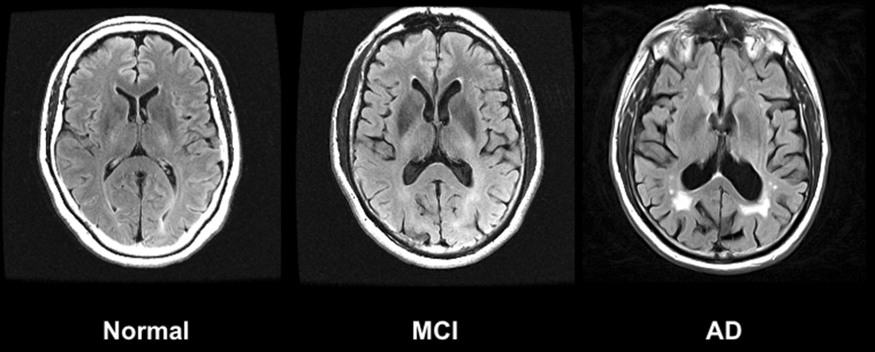 Alzheimer-Krankheit - MRT