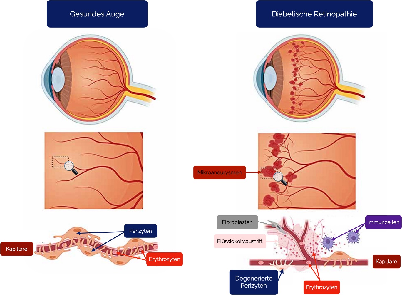 Diabetische Retinopathie