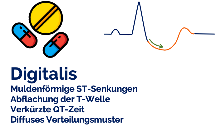Digitalis im EKG