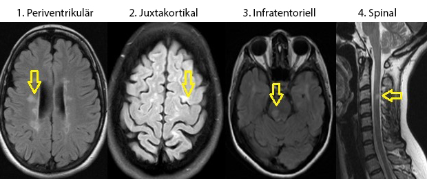 Typische Läsionen bei Multipler Sklerose