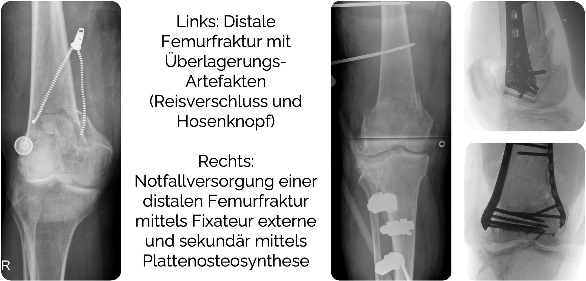 Distale Femurfraktur