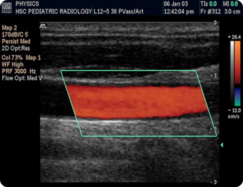Doppler-Modus - Darstellung der A. carotis interna