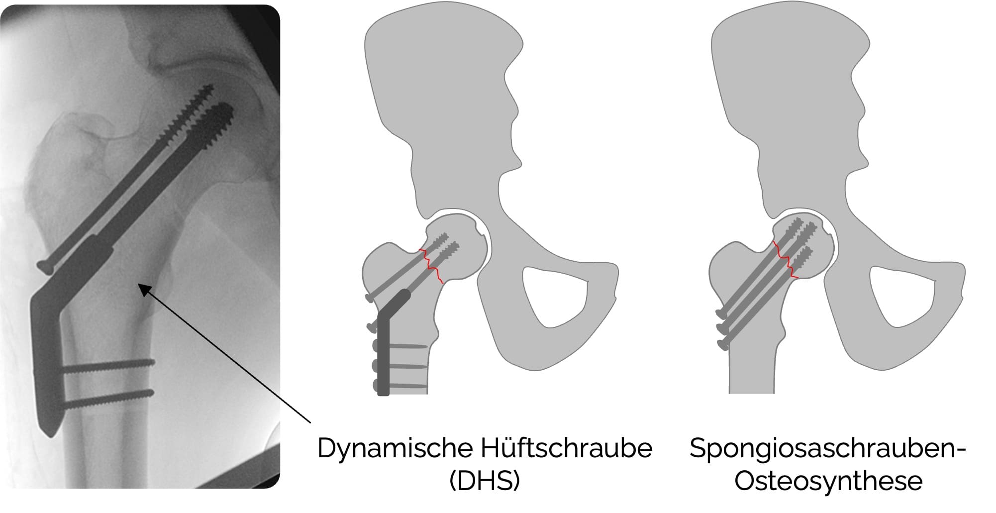 Operative Therapie bei Schenkelhalsfraktur