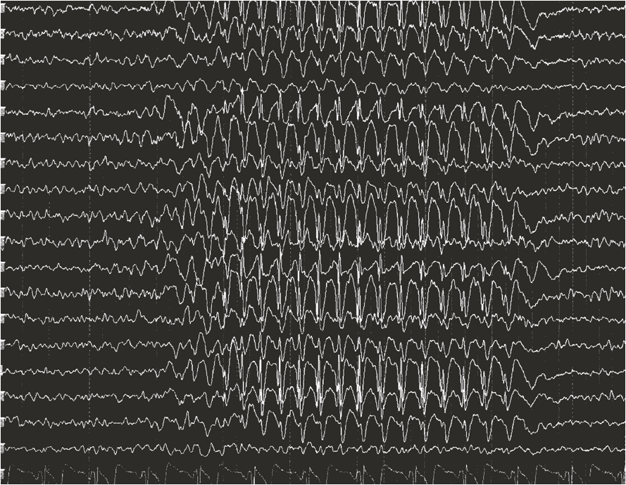 EEG bei Absencen Epilepsie