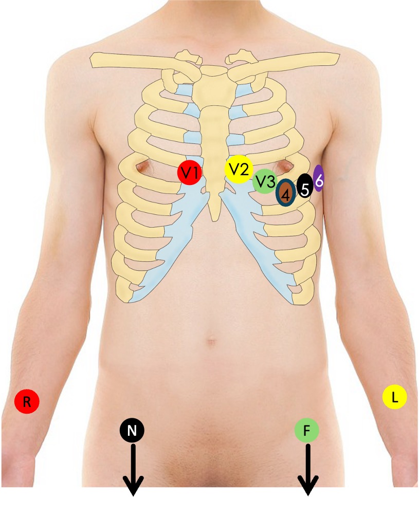 EKG-Elektrodenplatzierung für ein 12-Kanal-EKG