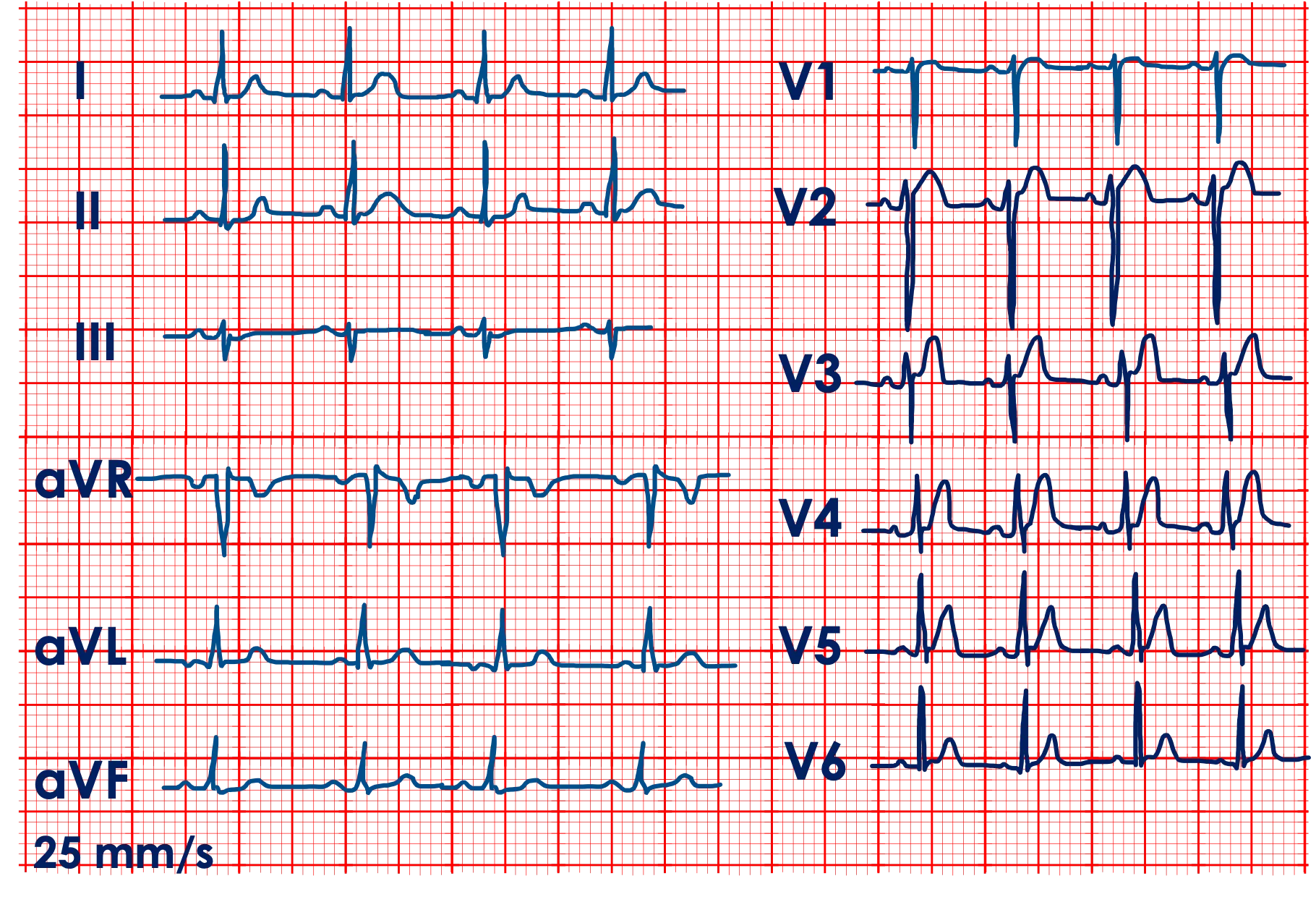 EKG-Fallbeispiel: Sinustachykardie