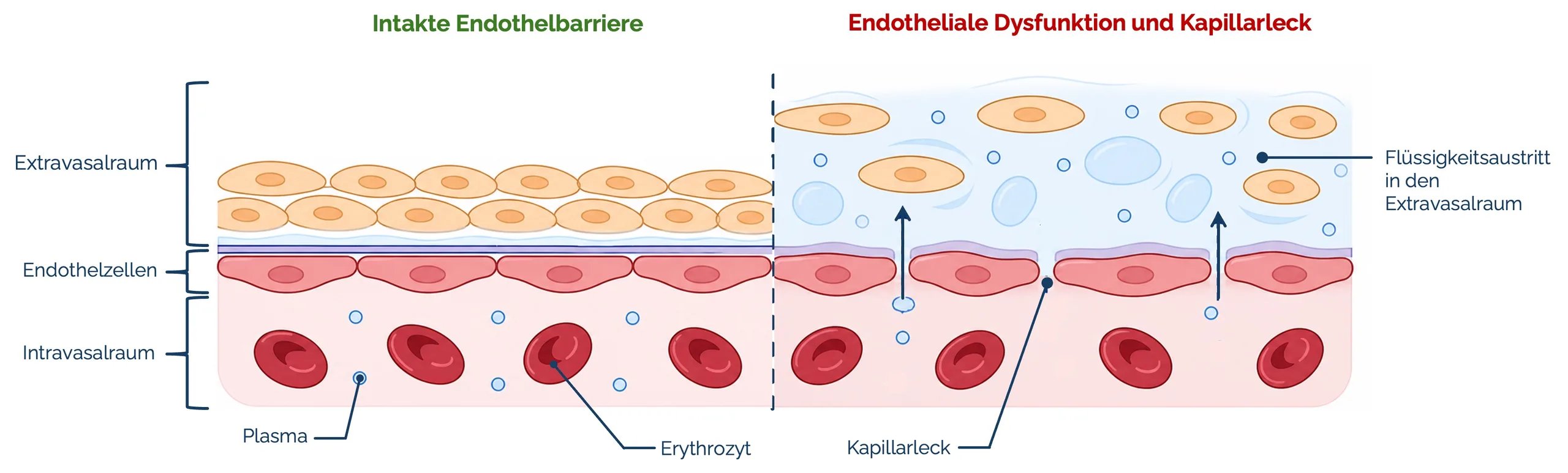 Endotheliale Dysfunktion und Kapillarleck