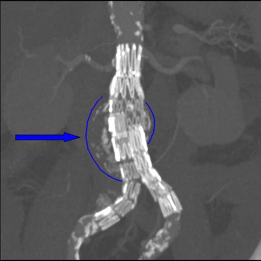 CT-Angiographie mit einer Y-förmigen Aortenprothese