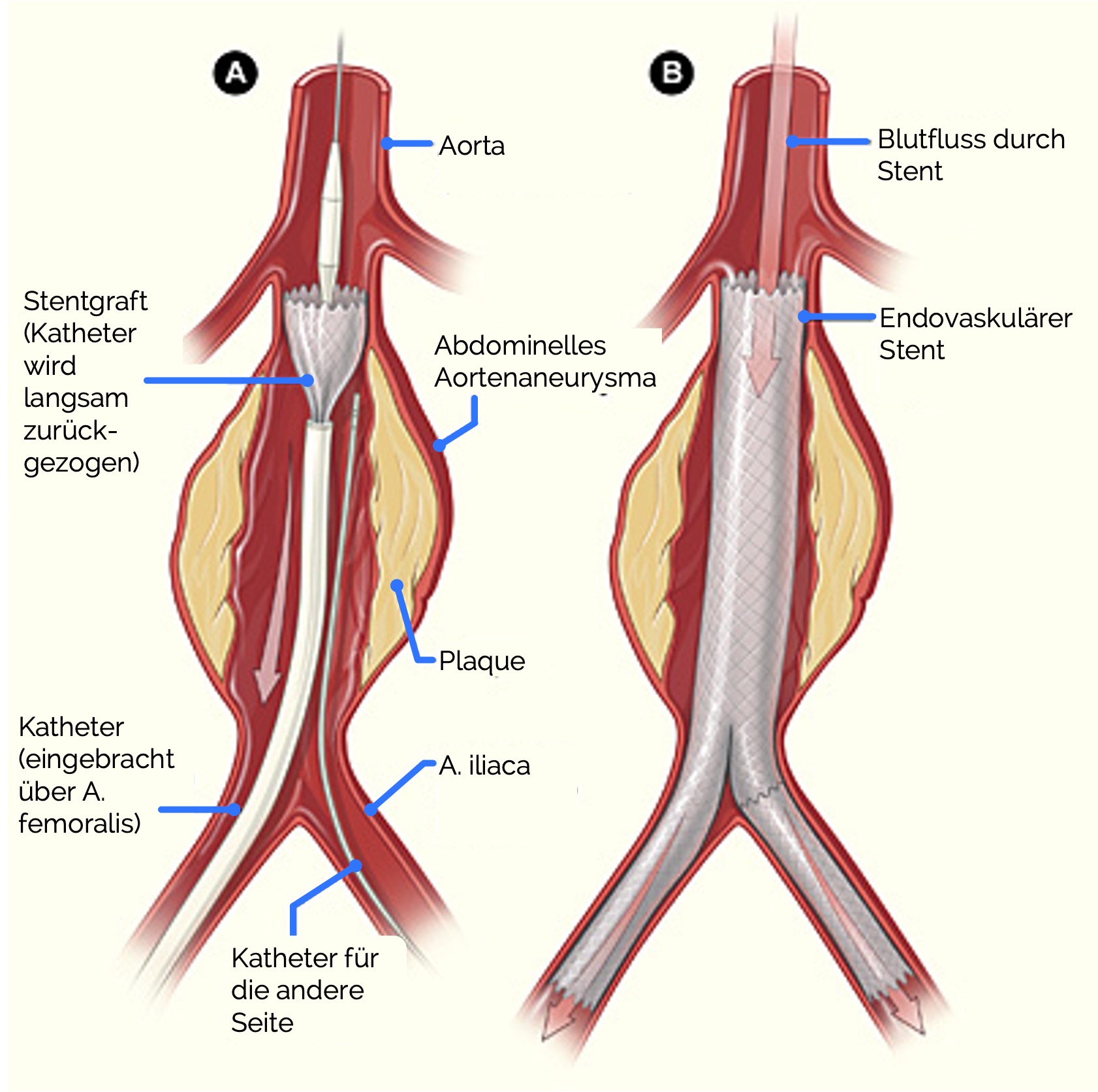 Endovascular Aneurysm Repair (EVAR)