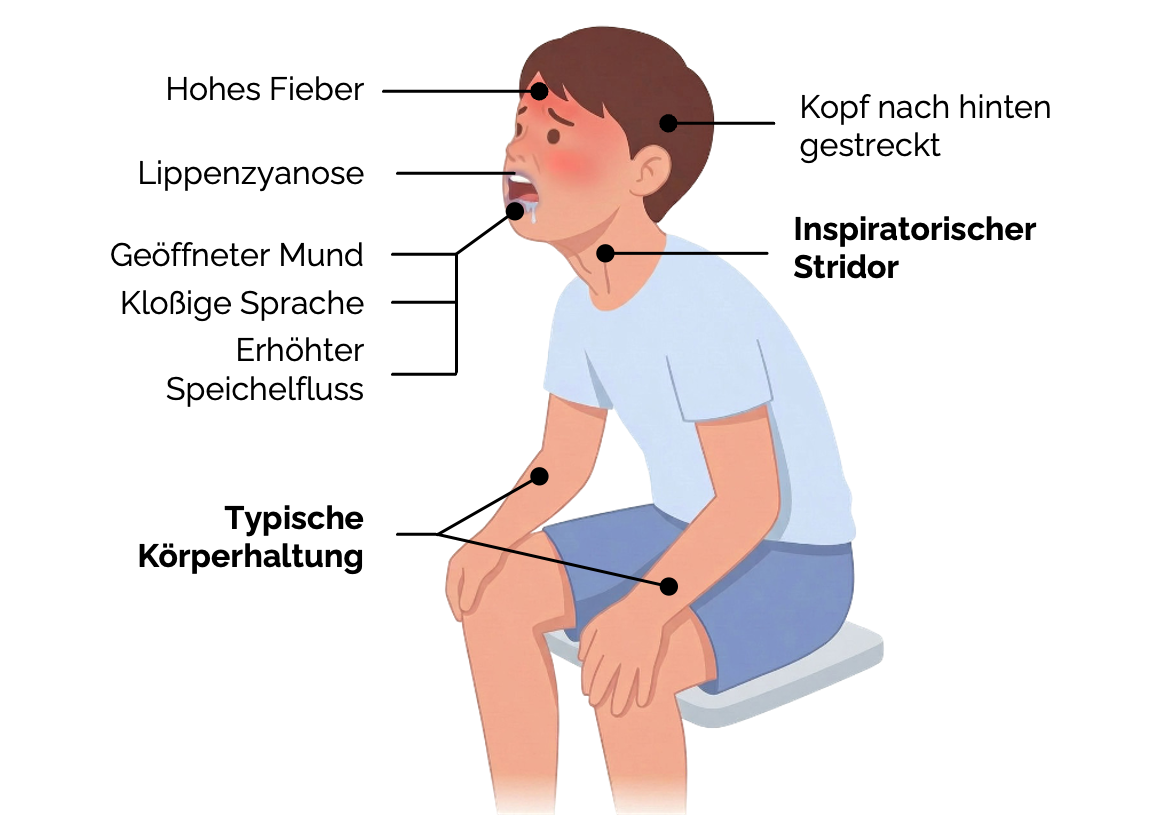 Epiglottitis Symptomatik
