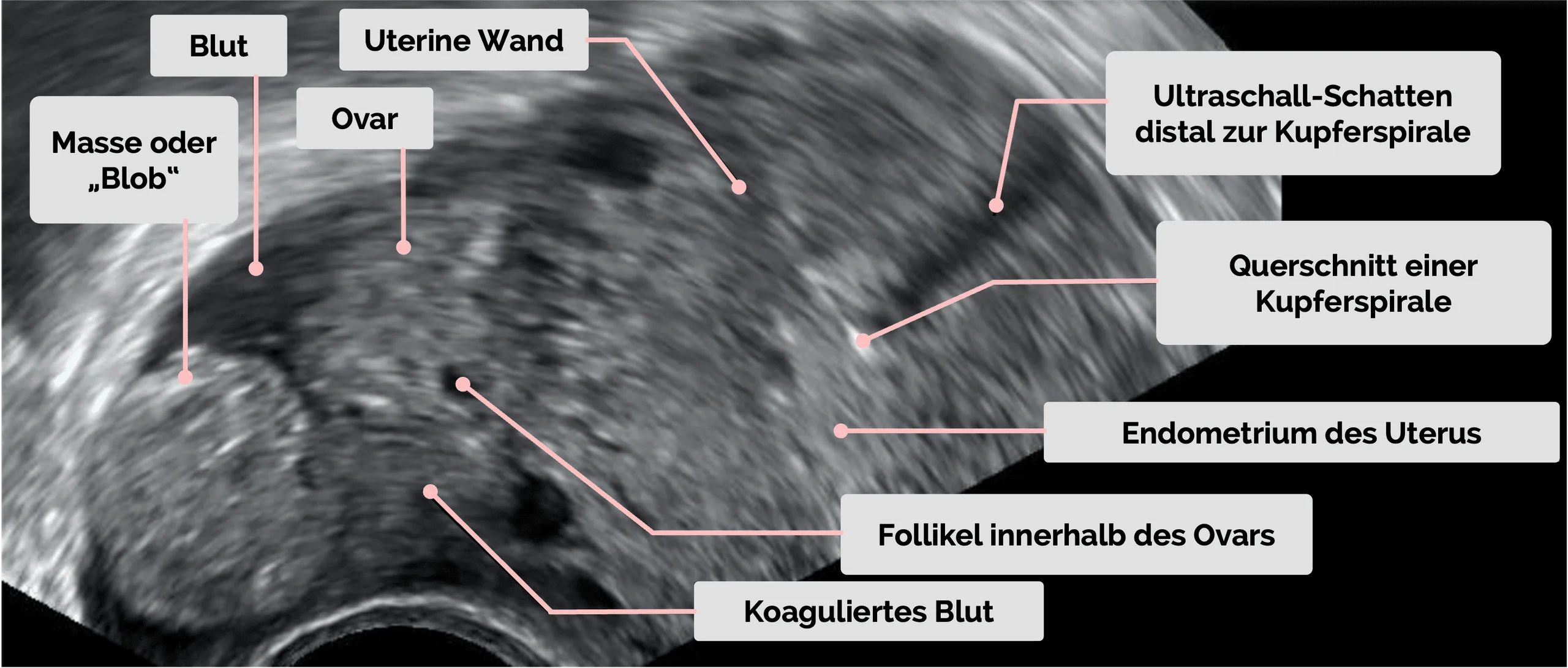 Extrauteringravidität in der Sonographie