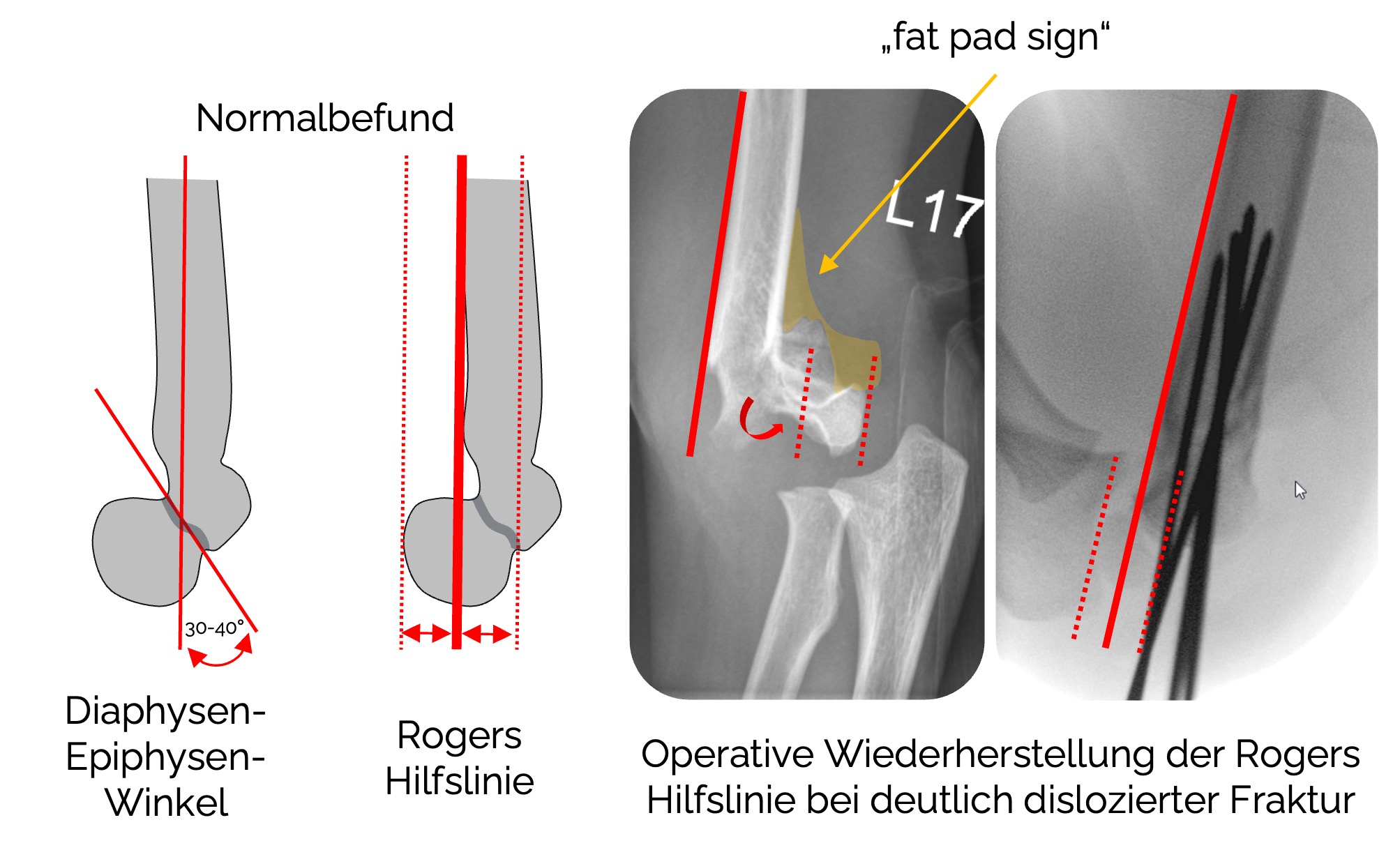 Röntgendiagnostik des Ellenbogengelenks