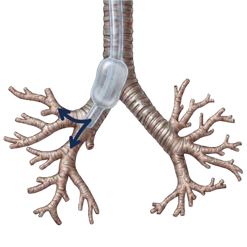 Fehllage des Endotrachealtubus