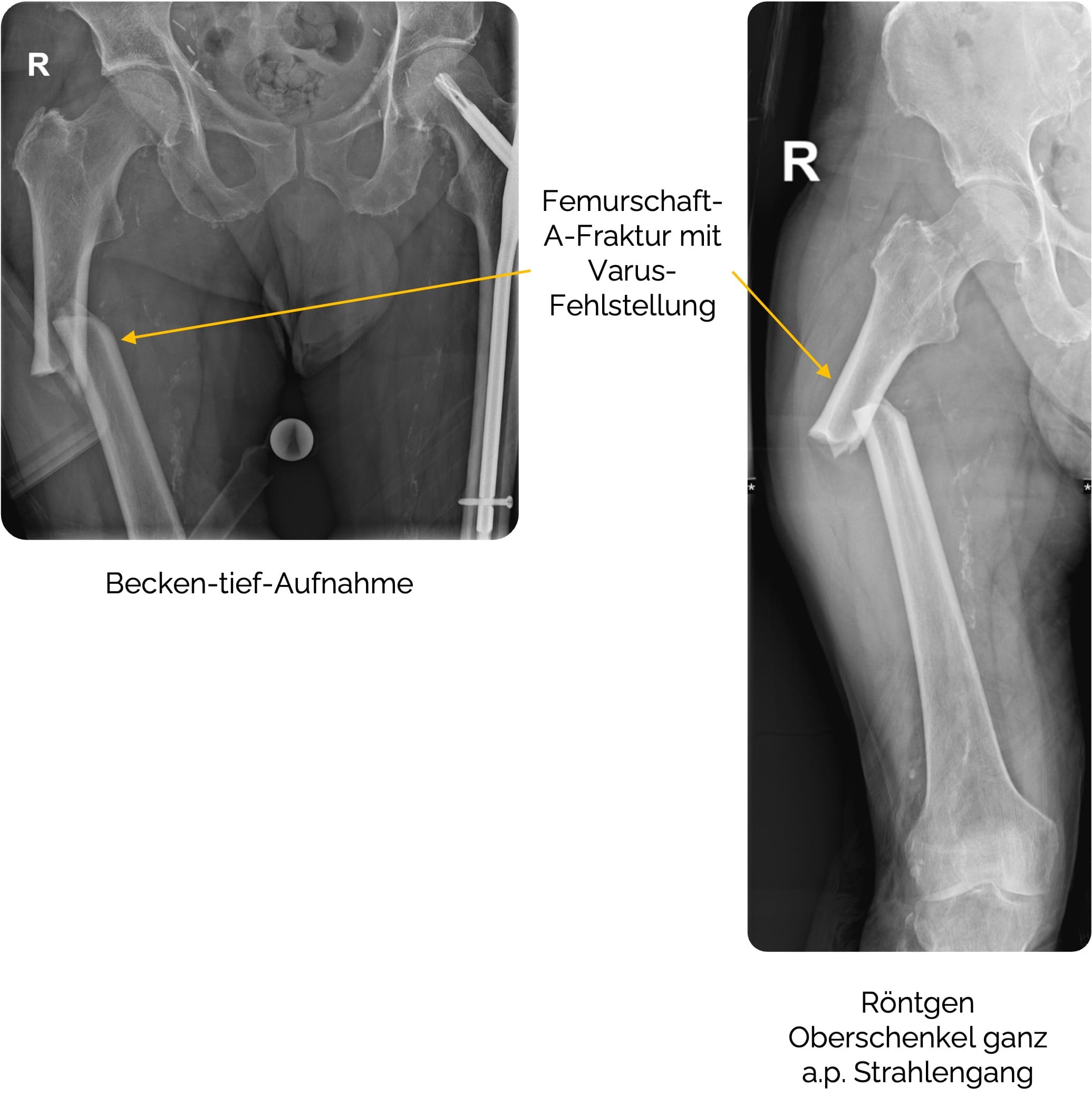 Femurschaft-A-Fraktur mit Varus-Fehlstellung