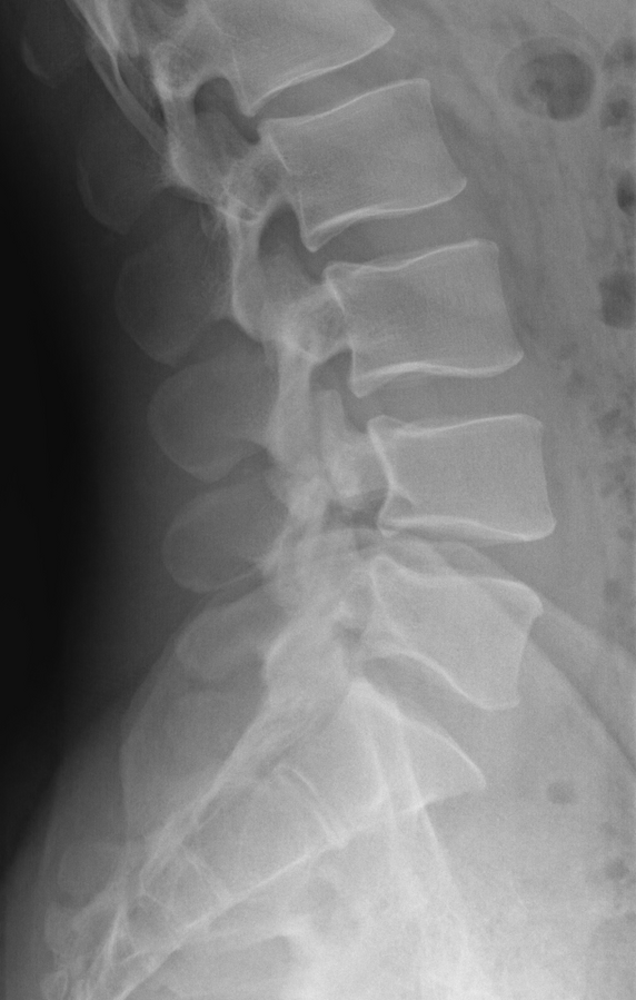 Osteoporose - Fischwirbel