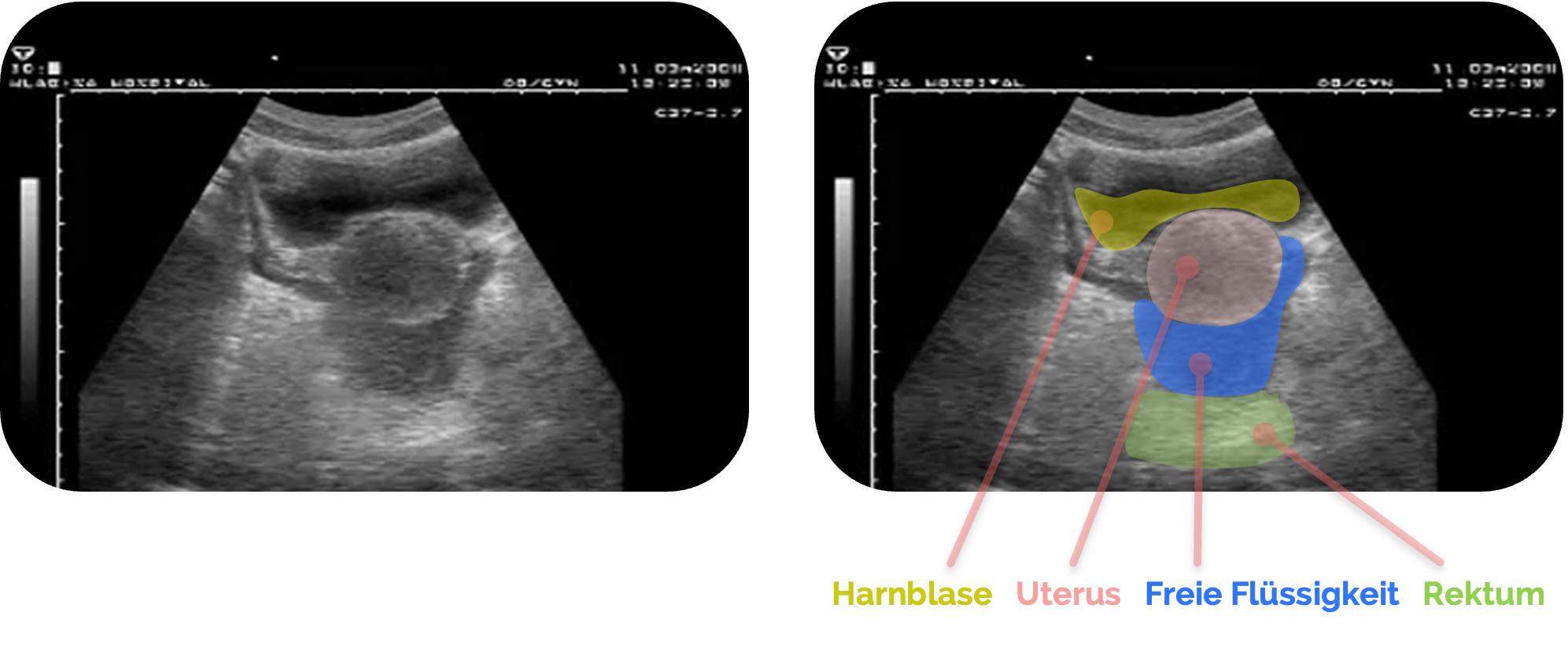 Freie Flüssigkeit im Douglas-Raum