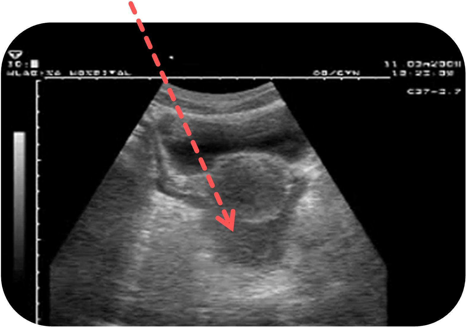 Freie Flüssigkeit im Douglas-Raum