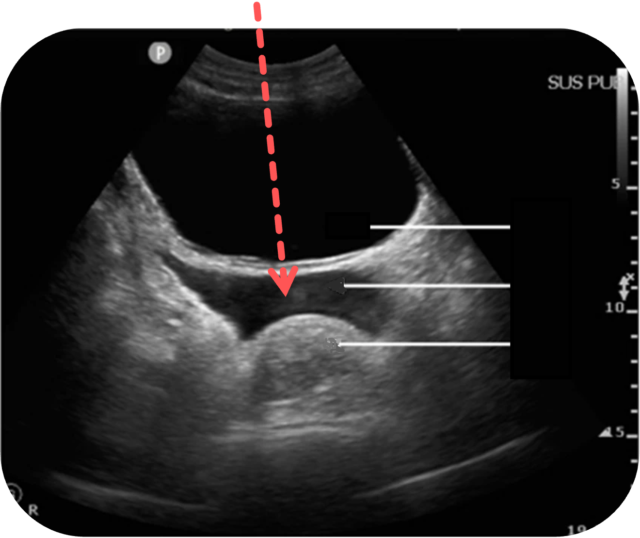 Freie Flüssigkeit in der Excavatio rectovesicalis