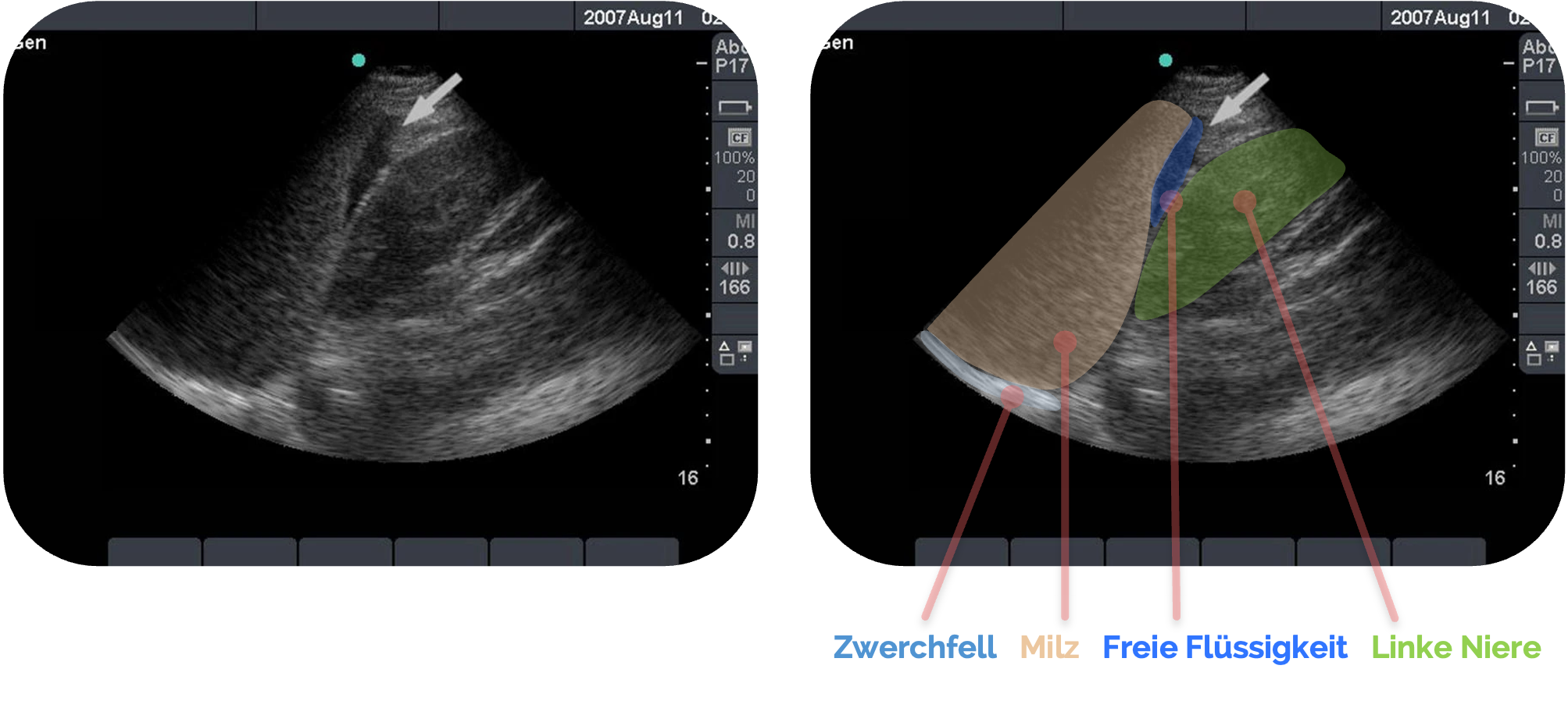 Freie Flüssigkeit im Koller-Pouch