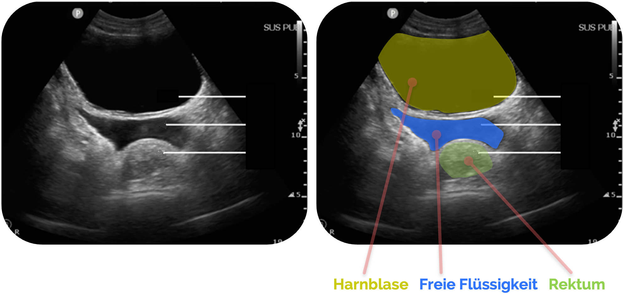 Freie Flüssigkeit in der Excavatio rectovesicalis