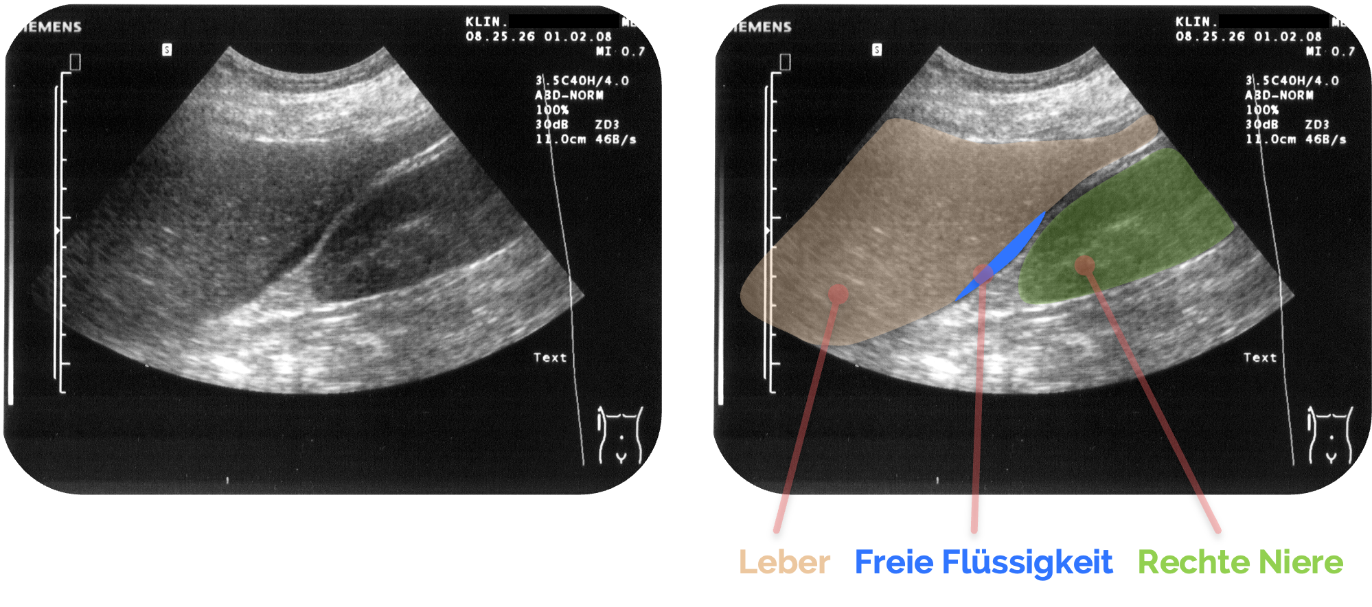 Freie Flüssigkeit im Morrison-Pouch, rechts blau markiert