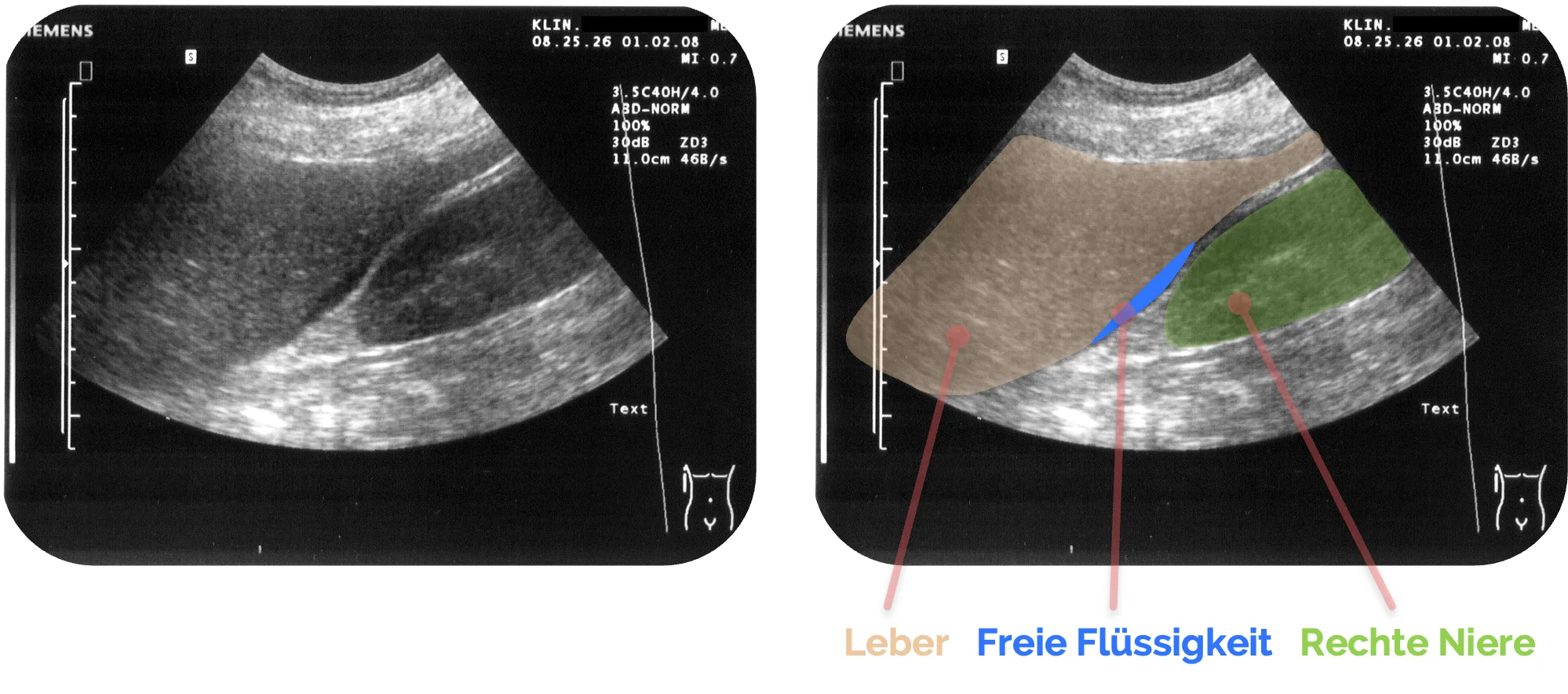 Freie Flüssigkeit im Morrison-Pouch, rechts blau markiert