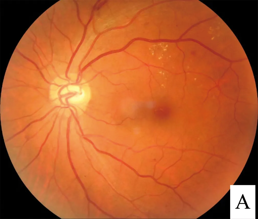 Diabetische Retinopathie