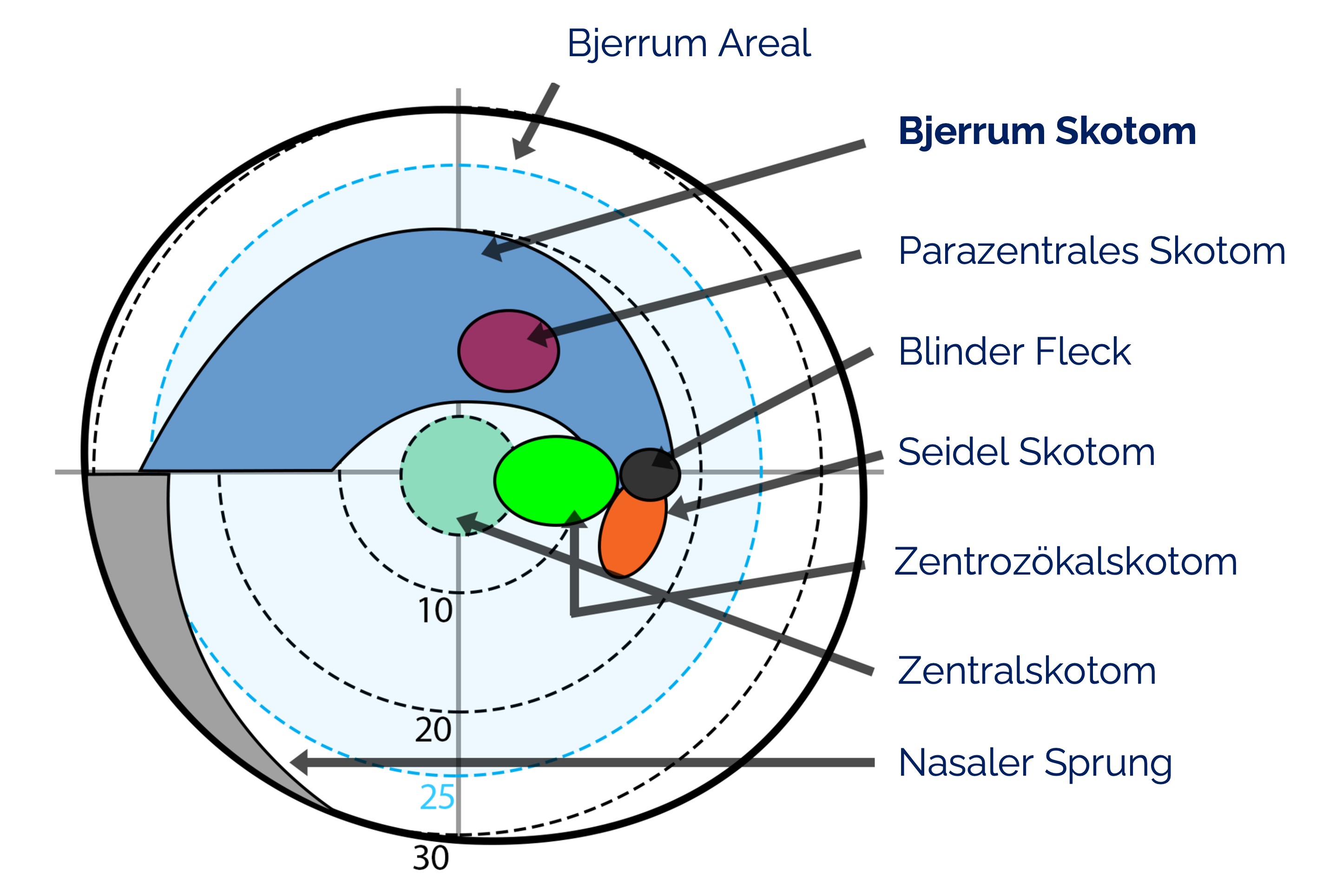 Typische Gesichtsfeldausfälle in der Perimetrie