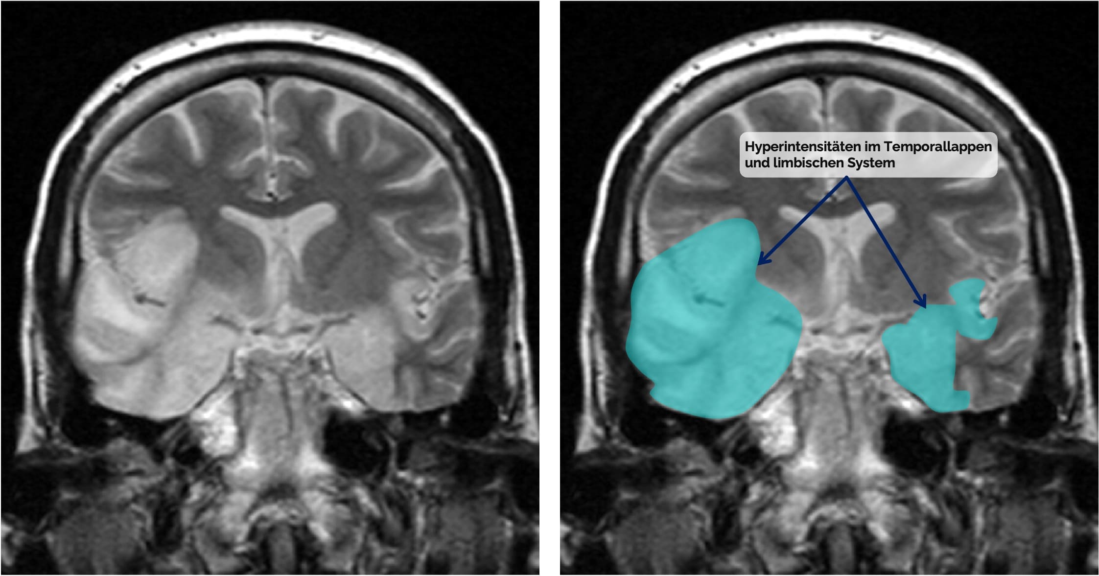 HSV-Enzephalitis im cMRT